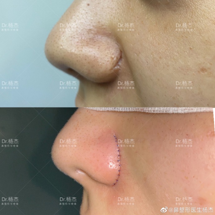 鼻翼疤痕产生原因及疤痕的影响因素