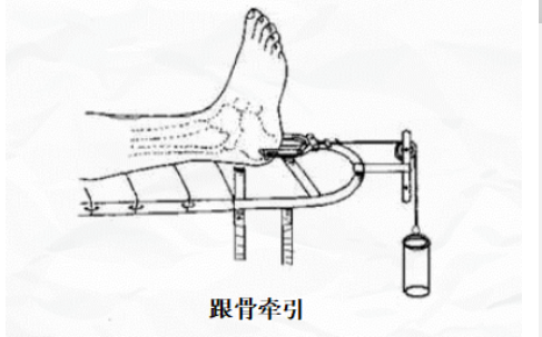 但由于跟骨牵引架为不锈钢材质,长期使用可能存在医疗器械压力