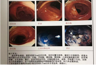 贵阳东大肛肠医院:小小肠道息肉竟是肠癌前兆!