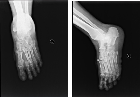 ct三维重建示:左足第1-5跖骨基底部,第2,3跖骨头骨折,跖跗关节脱位