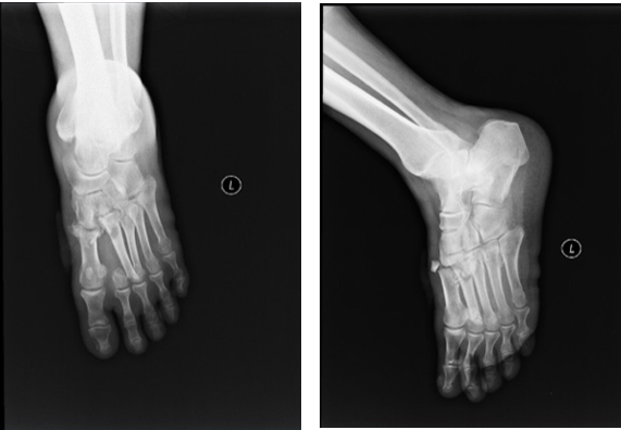 x片示:左足第1-4跖骨骨折,内侧楔骨骨折,中间楔骨骨沾 .