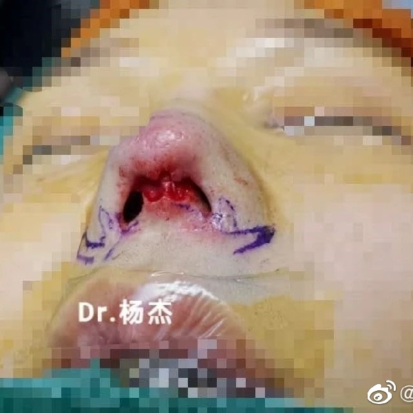 鼻翼疤痕修复|修复空间难易程度判断和修复时机选择