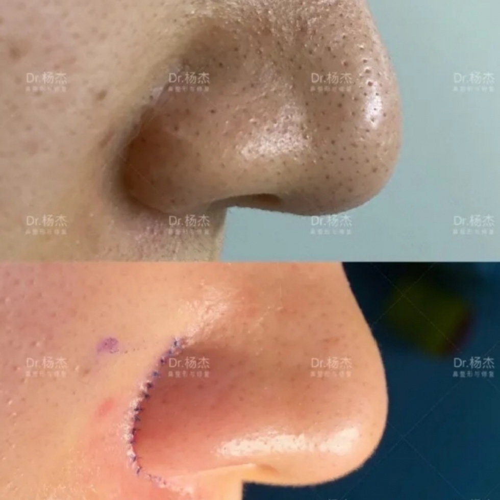 鼻翼缩小疤痕修复术前准备和术后护理