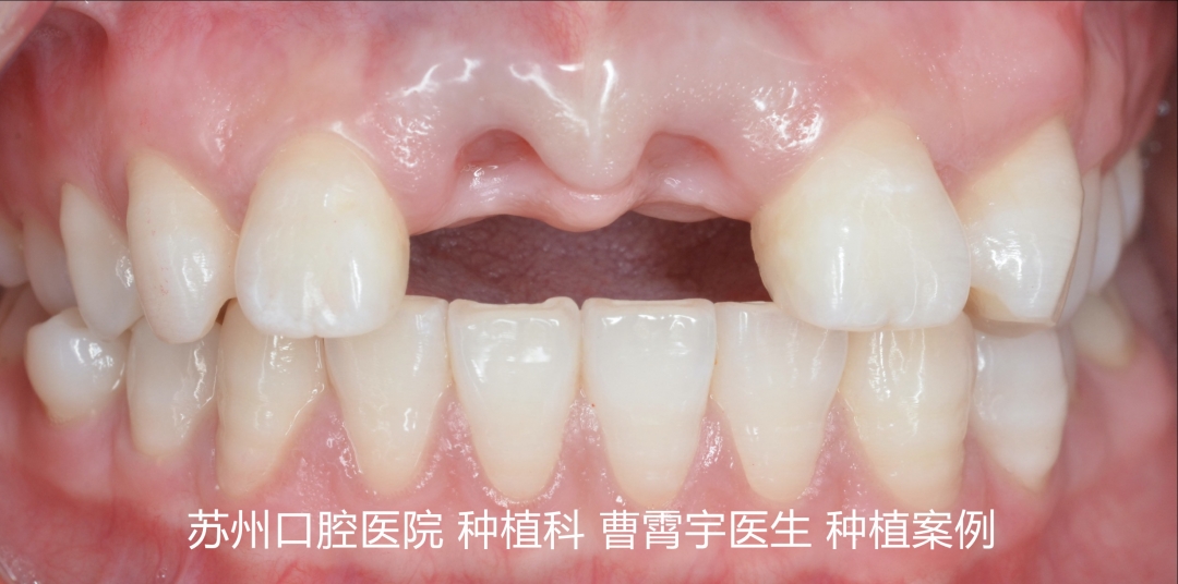 曹霄宇案例術前.jpg