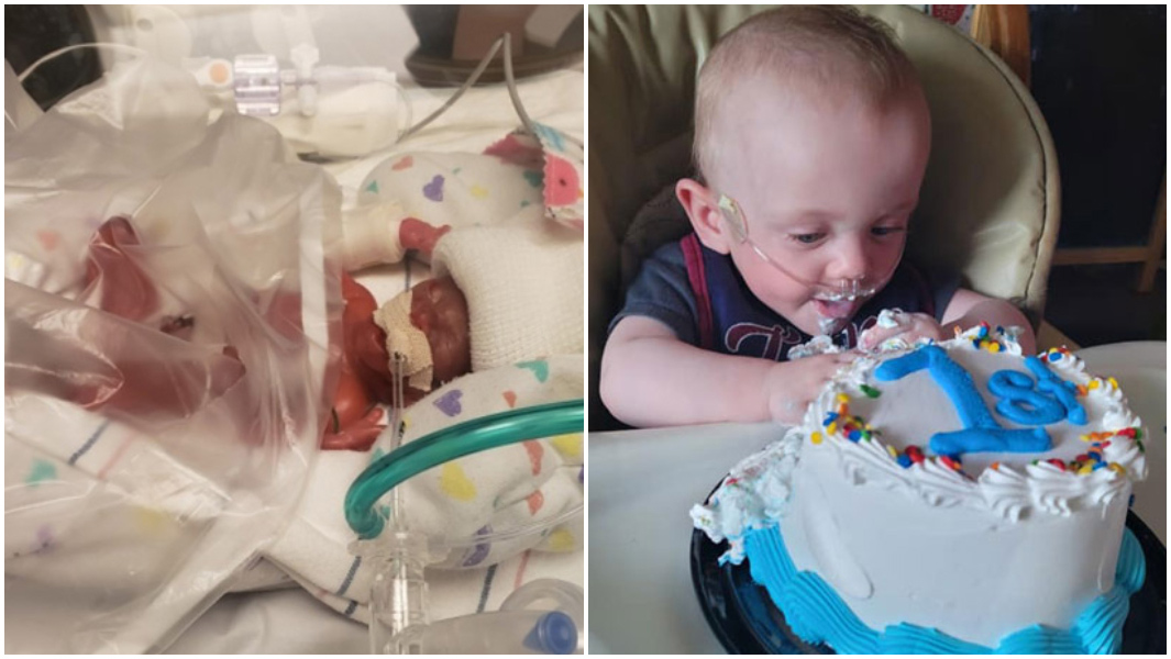 most-premature-baby-days-old-and-celebrating-first-birthday-with-cake_tcm25-663672.jpg