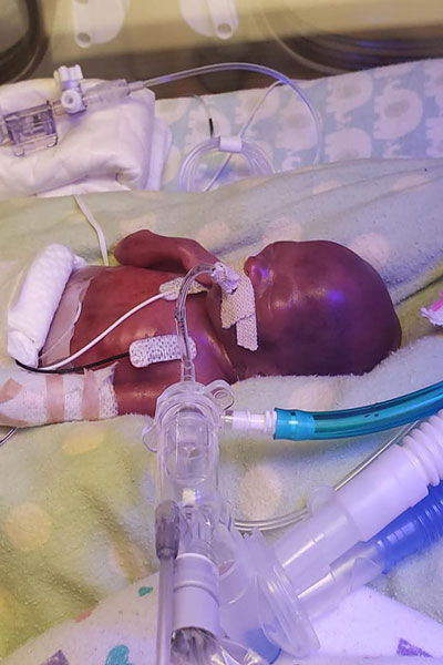 most-premature-baby-richard-hutchinson-days-after-delivery_tcm25-663420.jpg