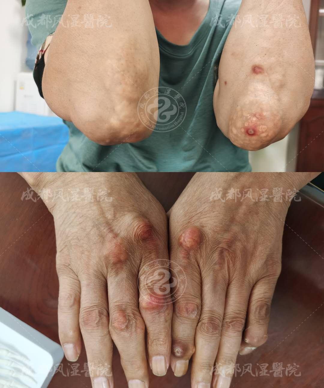 别人患病十年才长痛风石,你怎么一年就长了?