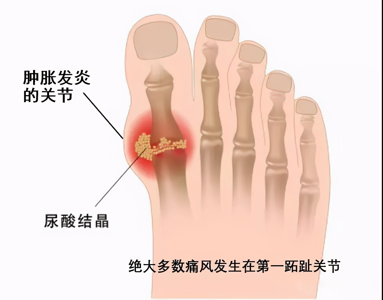 痛风患者尿酸高导致骨质疏松骨密度低不是补钙那么简单