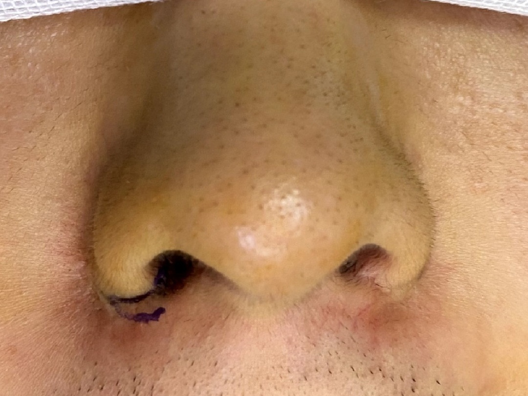 9.鼻半侧缺损的修复-口腔科学-医学