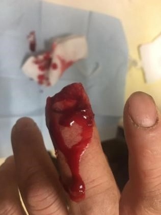 受伤照片及x片所示:当地医院x片提示:左手中指末节皮肤缺损,末节指骨